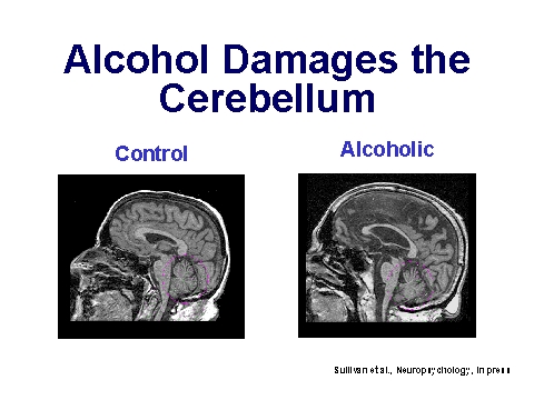 Alcohol Damages the Cerebellum,