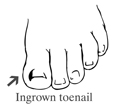 Drawing of a foot showing an ingrown toenail.