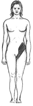 Diagram of the front side of a female figure. The pelvic region is shaded to show where kidney stones may cause pain.