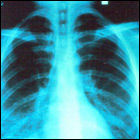 An x-ray of a lung showing infection with <em>Pneumocystis carinii</em> pneumonia.