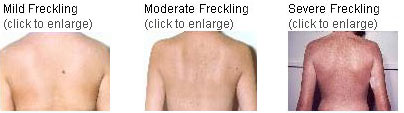 Examples of freckling on patients' backs.