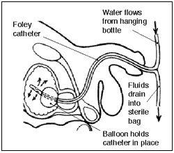 Side view diagram of male urinary tract with Foley catheter in place to drain urine.  A balloon near the tip holds the catheter in place.