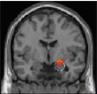 Amygdala activation in subject’s brain