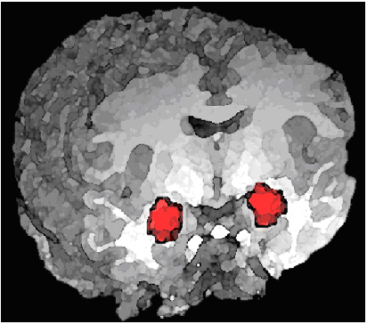 MRI rendering of brain