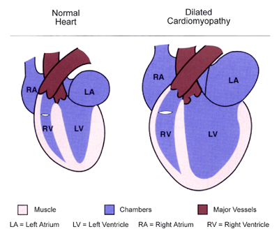 A heart in dilated cardiomyopathy 