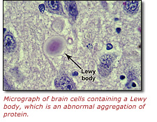 Micrograph of brain cells containing a Lewy body, which is an abnormal aggregation of protein