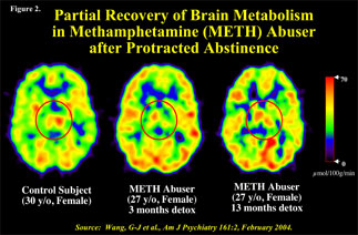 brain scans showing change in brain activity after extended abstinance from methamphetamine use - in text
