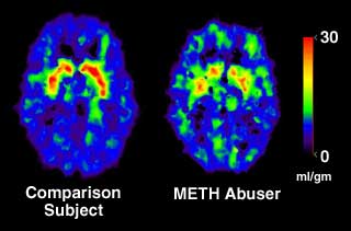 PET Scan of METH abuser compared to comparison subject