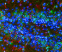 Dense collapsed and dying neurons (blue) in the dentate gyrus are surrounded by amoeboid phagocytic microglia (green) accompanied by a hypertrophy and elongation of processes of the astrocyte (red).