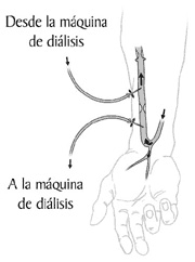 Una ilustración de un antebrazo con una fístula arteriovenosa. Las flechas muestran la dirección del flujo de sangre. Dos agujas se insertan en la fístula. Las etiquetas explican que una aguja lleva la sangre hacia la máquina del dializador. La otra regresa la sangre desde la máquina del dializador.