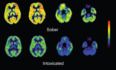 Brain activity during alcohol intoxication