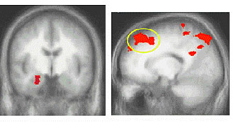 Left amygdala (left) and medial prefrontal cortex (circled in yellow, right) 