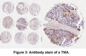 Figure 3: Antibody stain of a TMA