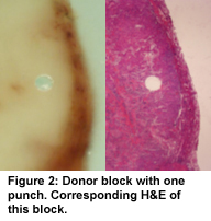 Figure 2: Donor block with one punch.  Corresponding H&E of this block