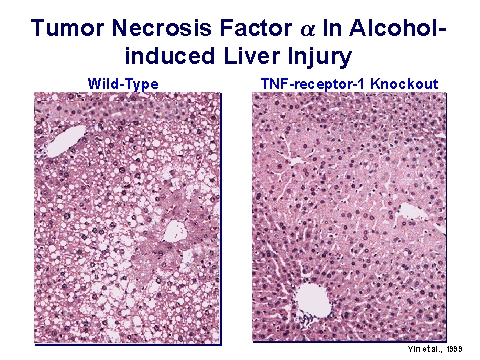 alcohol-induced liver damage