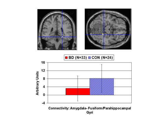 lower connectivity in emotion processing circuit