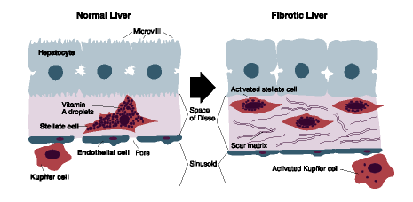 Progression of liver injury in alcoholic fibrosis