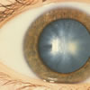 An acute sudden onset cortical cataract in a person with Type 1 (juvenile) diabetes