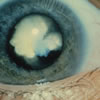 A white congenital cataract.