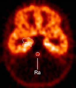 Image of PET Raphe Receptor Binding