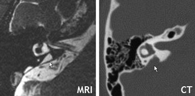 MRI  and CT scans showing EVA