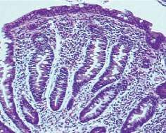 Image of Athophy of the villi in CD