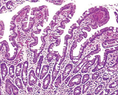 Image of Normal mucosa with villi