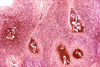 <em>Schistosoma</em> Parasite Eggs in Bladder