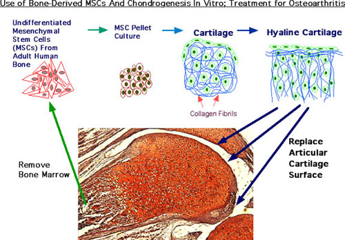 Photo of Use of Bone-Derived MSCs and Chondrogenesis in Vitro; Treatment for Osteoarthritis.