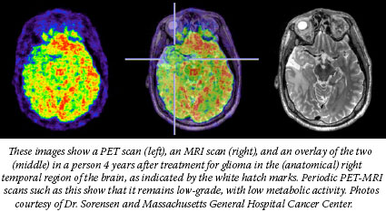 These images show a PET scan (left), an MRI scan (right), and an overlay of the two (middle) in a person 4 years after treatment for glioma in the right temporal region of the brain. Period PET-MRI scans such as this show that it remains low-grade, with low metabolic activity. Photos courtesy of Dr. Sorensen and Massachusetts General Hospital Cancer Center.