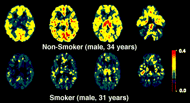 Effects of Cigarette Smoking on MAO