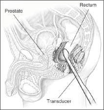 A transducer is inserted into the rectum of a male in this illustration, with the transducer, rectum, and prostate labeled.