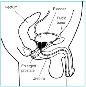 Side view diagram of male urinary tract showing how an enlarged prostate can squeeze the urethra and block urine flow.