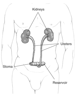 A male figure with the kidneys, ureters, reservoir, and stoma labeled.