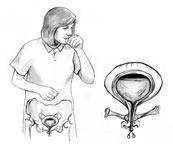 Ilustración de una mujer tosiendo con el hueso pélvico y la vejiga expuesta. Un recuadro enseña una toma agrandada de una vejiga con una pelvis débil que permite que la orina se escape.