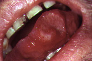 Photo: Aphthous (AF-thus) ulcers