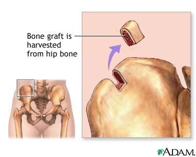 Bone graft harvest