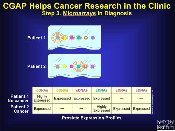 CGAP Helps Cancer Research in the Clinic: Step 3. Microarrays in Diagnosis