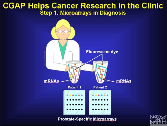 CGAP Helps Cancer Research in the Clinic: Step 1. Microarrays in Diagnosis