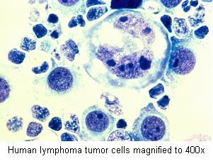  Human lymphoma tumor cells magnified to 400x