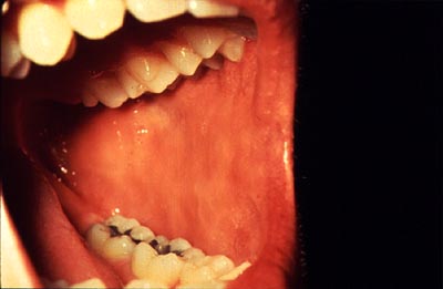 Photograph of examination of left buccal mucosa