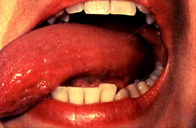 Photograph of examination of the tongue left margin