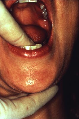 Photograph of palpation of the floor of a patient's mouth