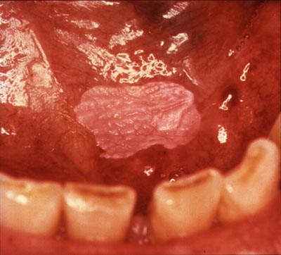 Photograph of homogenous leukoplakia inside of the mouth