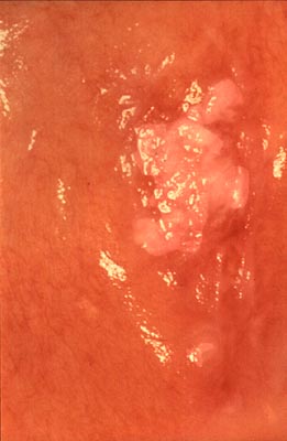 Photograph of the skin inside the mouth showing leukoplakia with early squamous cell carcinoma