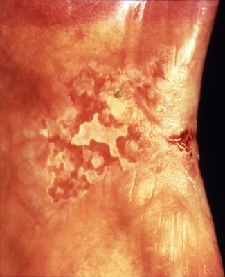 Photograph of erythroleukoplakia with candida infection