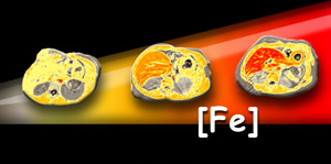 Workshop on Iron Overload: Mechanisms, Measurement, and Management, October 27�, 2008