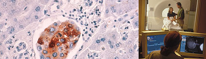 Image on left: Microscopic slide view of a cluster of malignant breast cancer cells, with their brown-staining cytoplasm, that have metastasized to the liver. Image on right: Caucasian girl, father, and female technician:  Technician in the foreground at the computer console for a CT scan room; in the background, girl sits up on CT scanning table with father standing beside her, his hand on her shoulder.