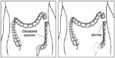 Drawings of ostomy surgery. The first shows the large intestine with the diseased section (labeled) detached from the healthy section. The second shows the healthy section attached to a stoma (labeled).