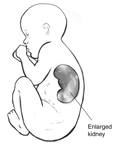 Drawing of a fetus with enlarged kidney visible, as seen in an ultrasound. The enlarged kidney is labeled.